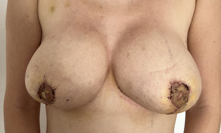 Bruststraffung mit Implantat - 81489