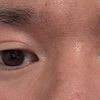 Suche Experten in Berlin für asiatische Augen asymmetrische augenlider