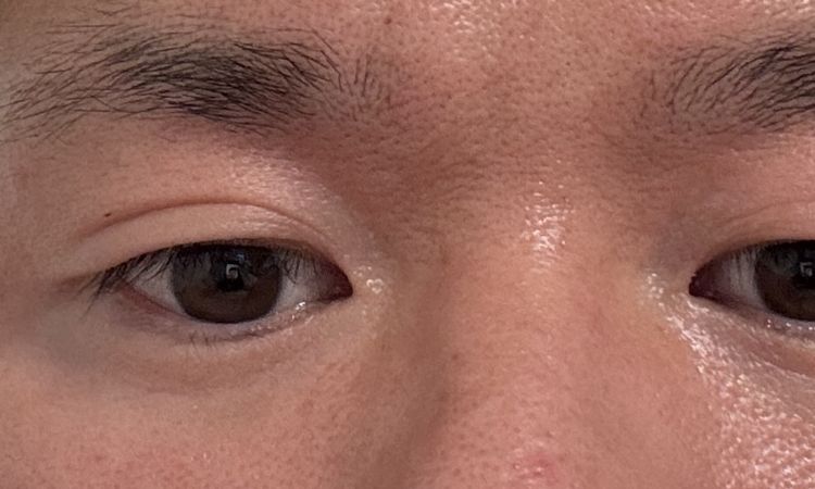 Suche Experten in Berlin für asiatische Augen asymmetrische augenlider - 81490