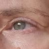 Nach Blepharoplastik Falte zur Nase hin