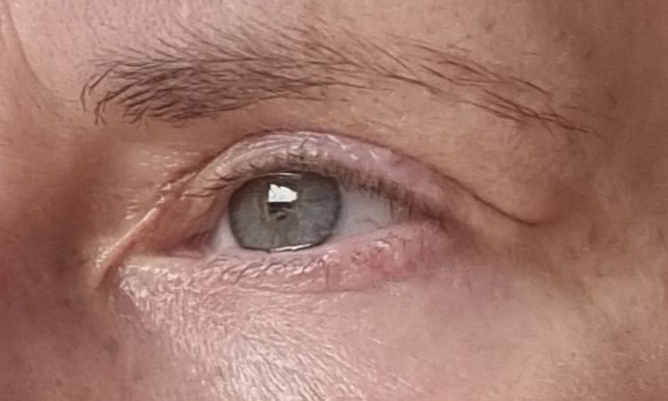 Nach Blepharoplastik Falte zur Nase hin - 81539