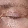 Nach Blepharoplastik Falte zur Nase hin