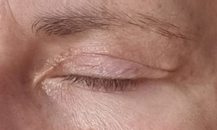 Nach Blepharoplastik Falte zur Nase hin - 81540