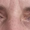 Nach Blepharoplastik Falte zur Nase hin