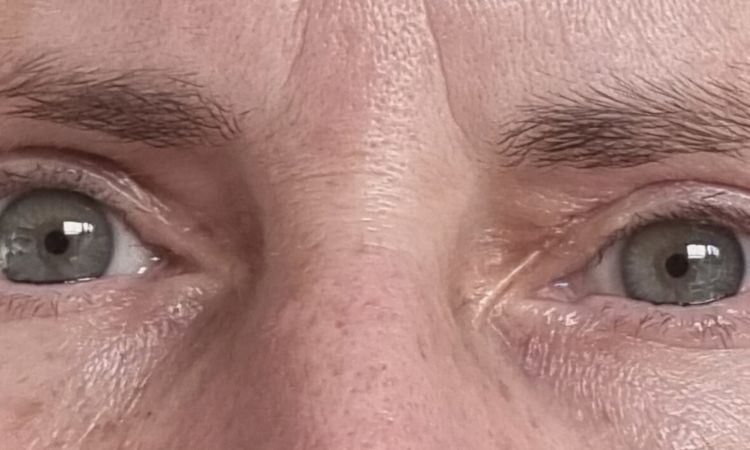 Nach Blepharoplastik Falte zur Nase hin - 81541