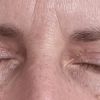 Nach Blepharoplastik Falte zur Nase hin