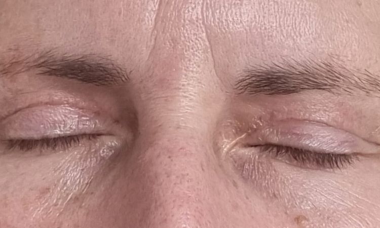 Nach Blepharoplastik Falte zur Nase hin - 81542