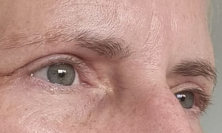 Nach Blepharoplastik Falte zur Nase hin - 81543