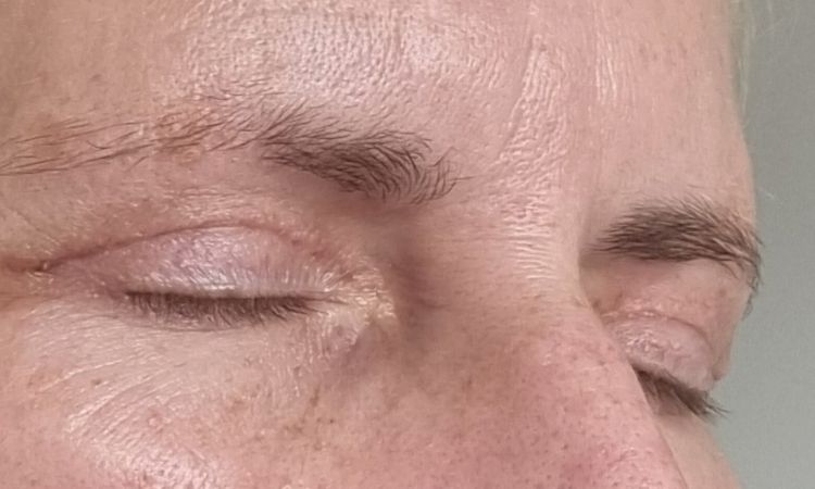 Nach Blepharoplastik Falte zur Nase hin - 81544