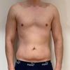 Asymmetrie nach Bauchdeckenstraffung
