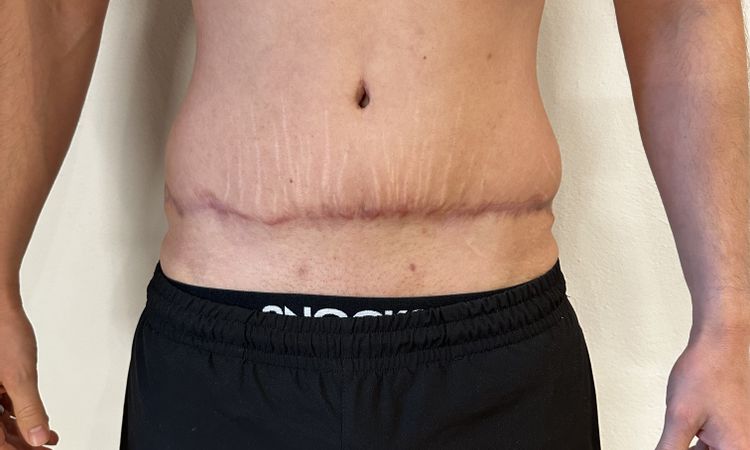Asymmetrie nach Bauchdeckenstraffung - 81551