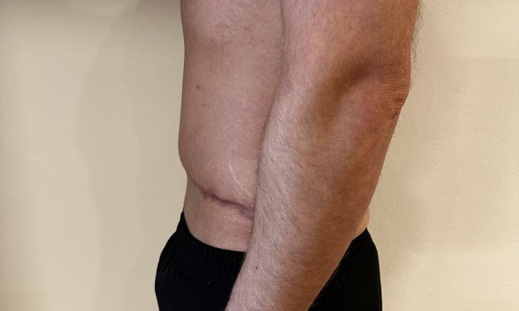 Asymmetrie nach Bauchdeckenstraffung - 81552