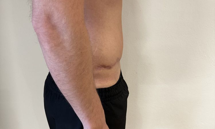 Asymmetrie nach Bauchdeckenstraffung - 81553