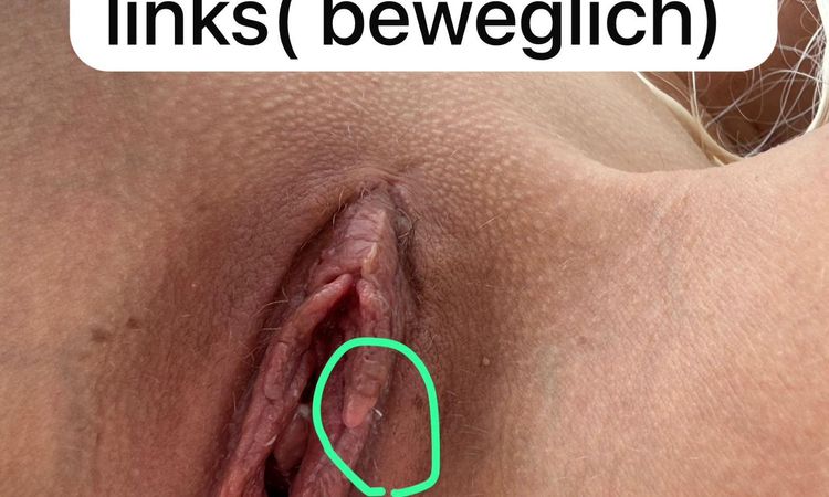 Schammlippenkorrektur - 81577