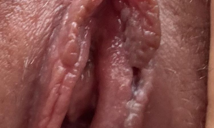 Schammlippenkorrektur - 81579