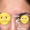 Delle und Schwellung nach Nasen OP