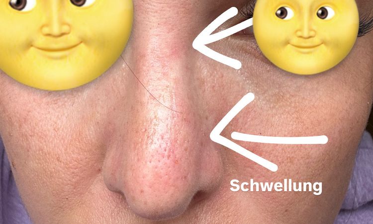 Delle und Schwellung nach Nasen OP - 81616