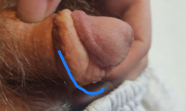 Bescheidungsverwachsungs korrektur zum erhalten der Vorhaut - 81620