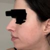 Lange Nasenlöcher nach Bullhorn Liplift - kann eine Nasenop helfen?
