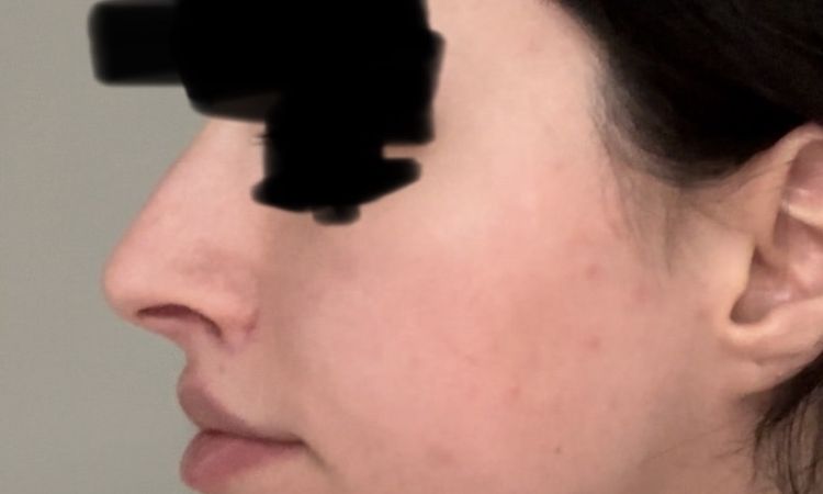 Lange Nasenlöcher nach Bullhorn Liplift - kann eine Nasenop helfen? - 81622