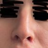 Lange Nasenlöcher nach Bullhorn Liplift - kann eine Nasenop helfen?