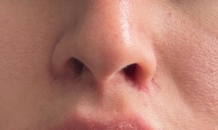 Lange Nasenlöcher nach Bullhorn Liplift - kann eine Nasenop helfen? - 81623