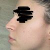 Lange Nasenlöcher nach Bullhorn Liplift - kann eine Nasenop helfen?