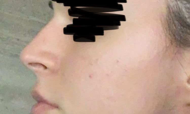 Lange Nasenlöcher nach Bullhorn Liplift - kann eine Nasenop helfen? - 81624