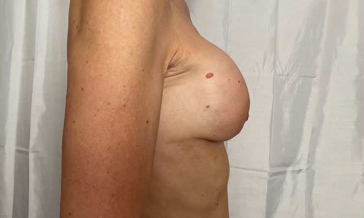 Implantate sitzen asymmetrisch, Brustwarzen zeigen teilweise stark nach unten - 81644