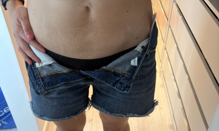 Übergang nach Liposuction am Unterbauch - 81647