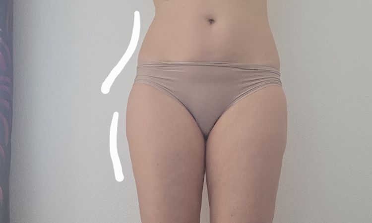 Asymmetrie nach Fettabsaugung - 81649