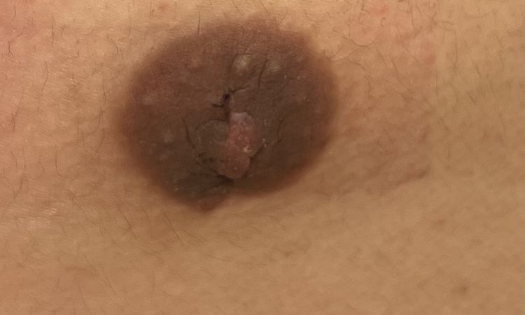 Heilungsverlauf nach Gynäkomastie Operation - 81653