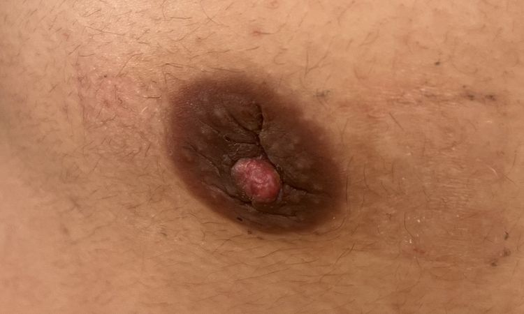 Heilungsverlauf nach Gynäkomastie Operation - 81657