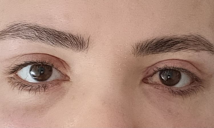 Asymmetrische Augen nach oberlidstraffung - 81661