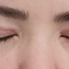 Asymmetrische Augen nach oberlidstraffung