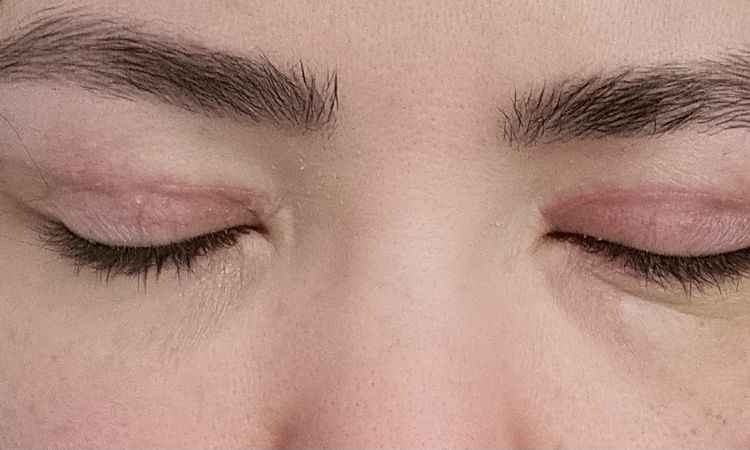Asymmetrische Augen nach oberlidstraffung - 81662