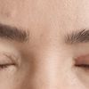 Asymmetrische Augen nach oberlidstraffung