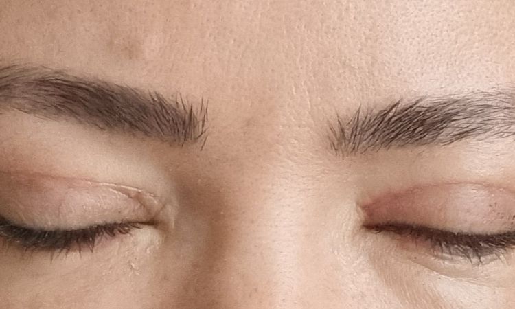 Asymmetrische Augen nach oberlidstraffung - 81663