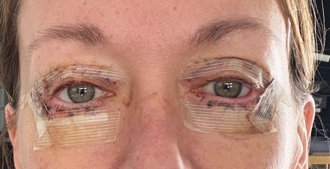 Suche Arzt in München für Kanthoplastik - 81711