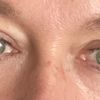 Suche Arzt in München für Kanthoplastik