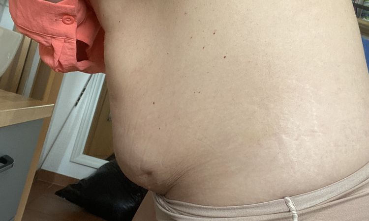 Asymmetrischer Bauch - 81744