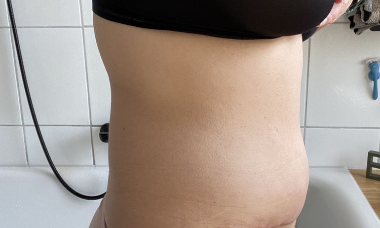 Asymmetrischer Bauch - 81745