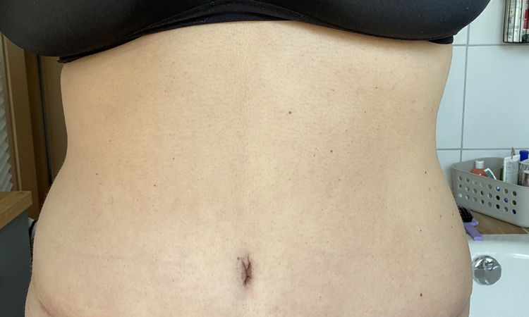 Asymmetrischer Bauch - 81750