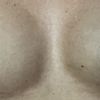 Asymmetrie nach Brustvergrößerung