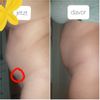 Liposuktion: kein Erfolg