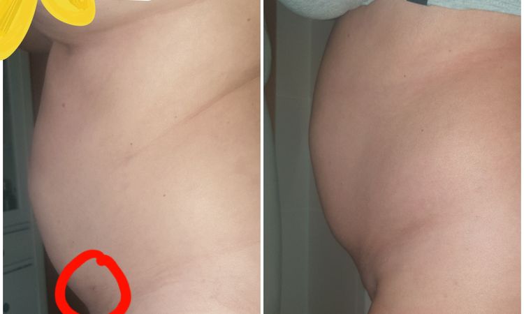 Liposuktion: kein Erfolg - 81776