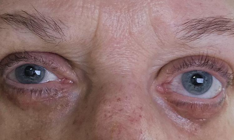 Ober- und Unterlidstraffung nach 4 Wochen - ist das noch normal? - 81801