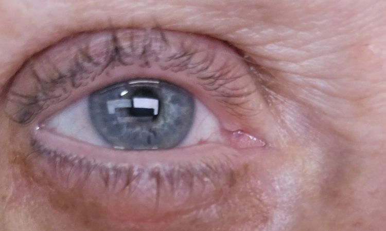 Ober- und Unterlidstraffung nach 4 Wochen - ist das noch normal? - 81802