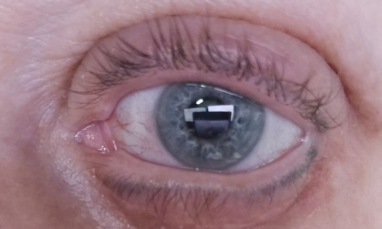 Ober- und Unterlidstraffung nach 4 Wochen - ist das noch normal? - 81803