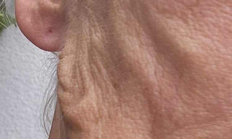 Fadenlifting Gesicht - 81812
